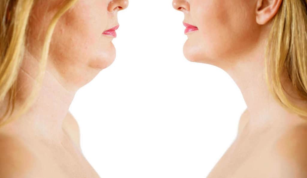 Double Chin treatment Salford before and after results