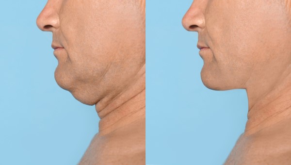 Which Non-Surgical Treatments Work Best for Jowls and Loose Skin Salford?