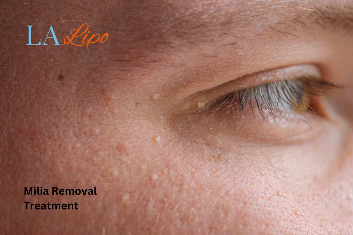 Cryopen Milia Removal: Is It the Easiest and Safest Option Salford?