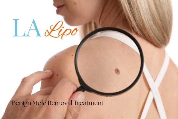 Woman having her inspection of blemish before mole removal Salford