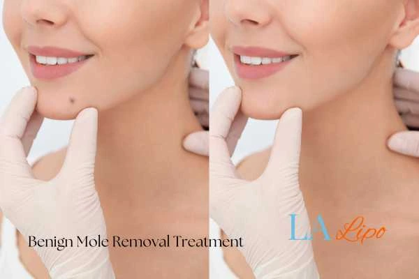 Before and after mole removal Salford treatment