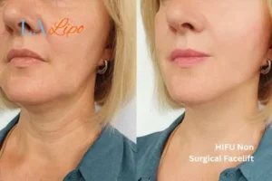 hi-fu for wrinkles Salford before and after results