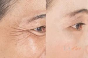 Before and after results of woman - HI-fu wrinkles reduction treatment Salford