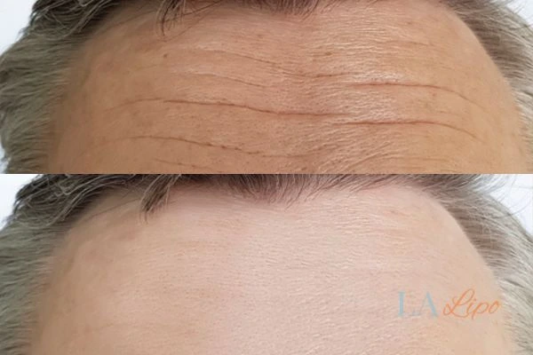 results of HIFU Salford on mans forehead to help reduce lines and wrinkles