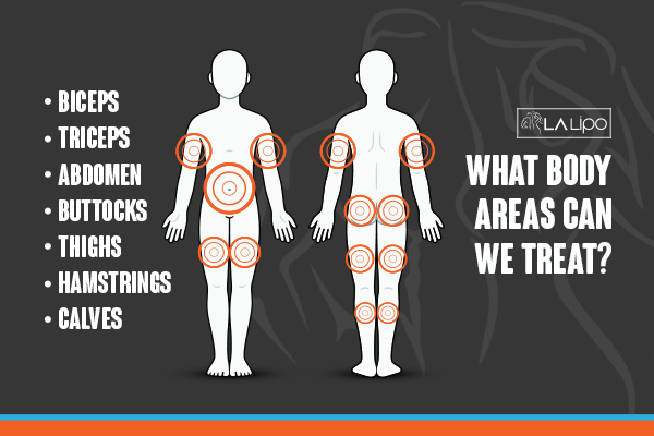 Graphic to show areas you can have LA-EMS Body Sculpting Salford treatment.