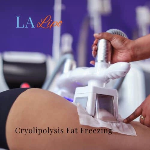 fat freezing - Cryolipolysis Salford