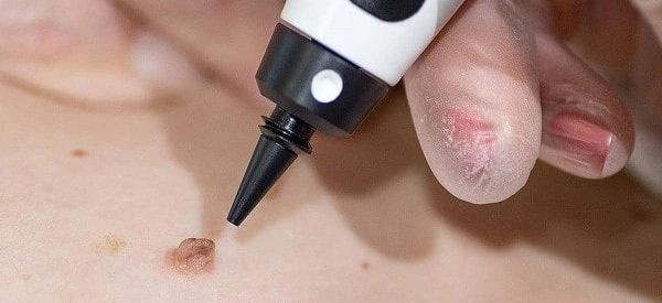 skin tag removal using cryopen Salford