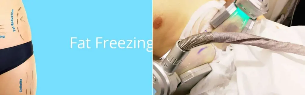 Fat freezing Salford on multiple areas of the body