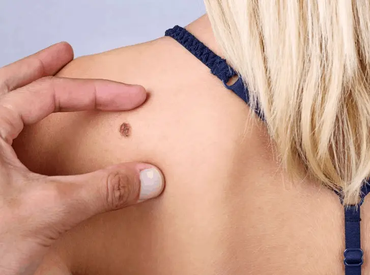 woman having mole removal Salford consultation before treatment.