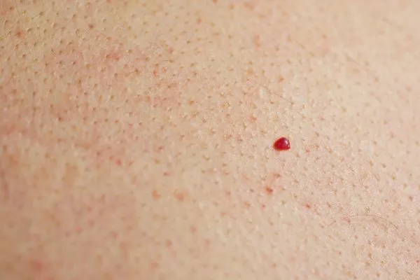 close up of a cherry angioma Salford