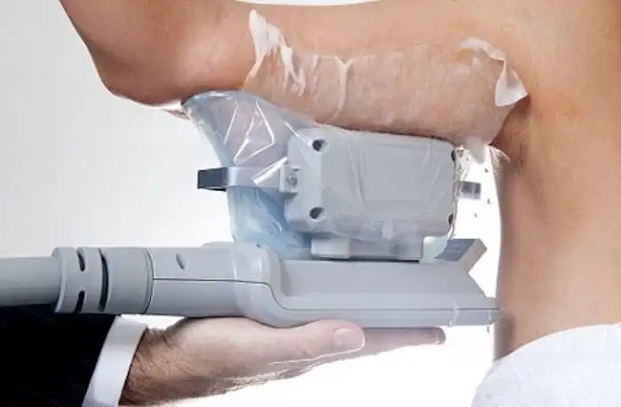 Picture of fat freezing Salford on the upper arms.