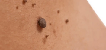 image of a skin tag Salford