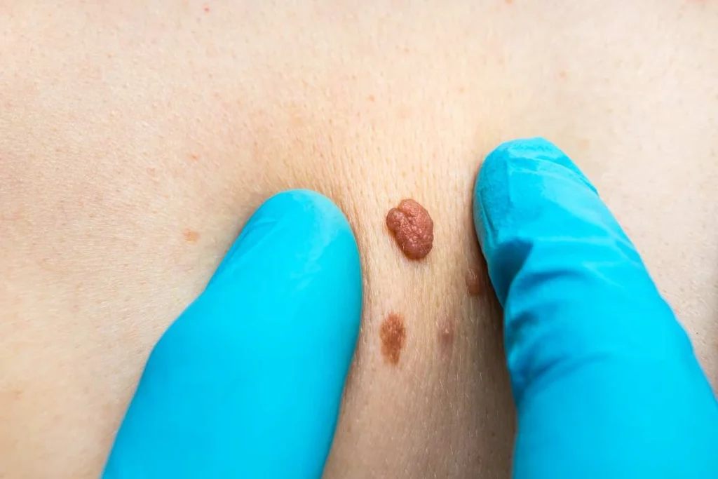 Consultant examining a skin tag Salford