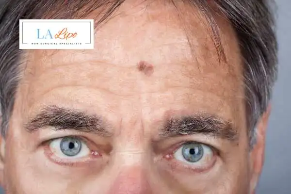 Solar Lentigo Removal Salford image of man with mark on his forehead