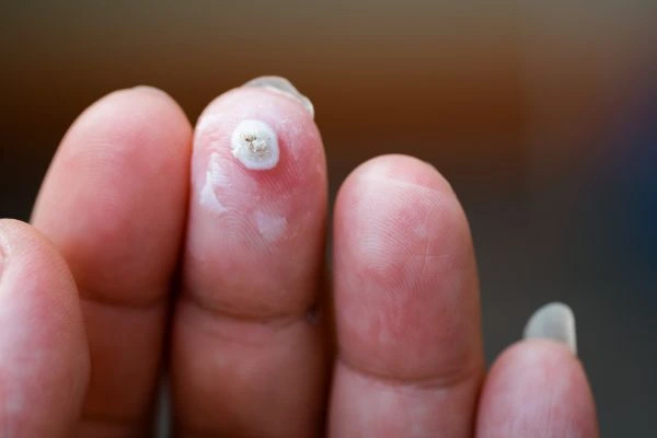 wart on person finger - cryotherapy to treat from LA LIPO Salford
