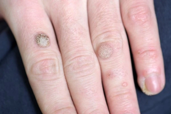 photo of warts on person hand - see wart removal Salford from LA LIPO