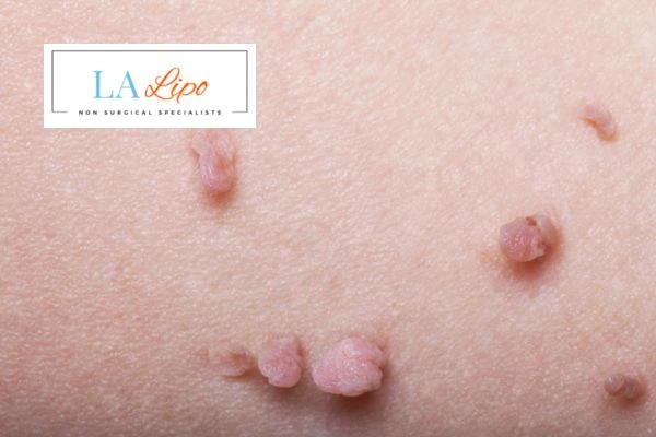Does cryopen skin tag removal Salford hurt? Find out now call our team today!
