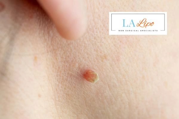 Book skin tag removal Salford today speak to our team now!