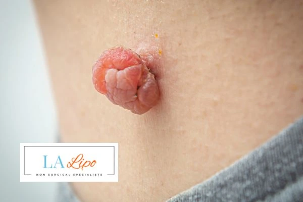 Interested in skin tag removal Salford? Concerned about the pain? Find out more today!