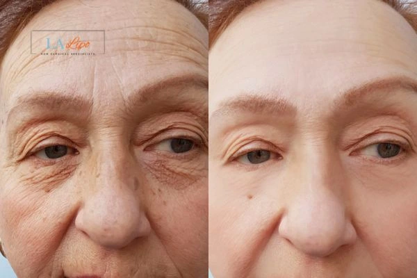 The powerful benefits of Morpheus8 Treatment Salford - Call Our team today!