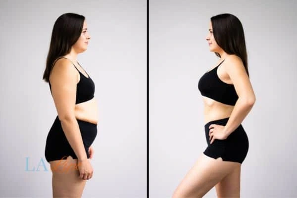 Picture of womans before and after using LA-EMS body sculpting to improve her core strength Salford