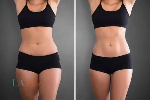 before and after results of non-surgical treatment to help a woman's body image and mental health Salford