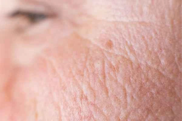 close up picture of a woman's face showing an age spot Salford