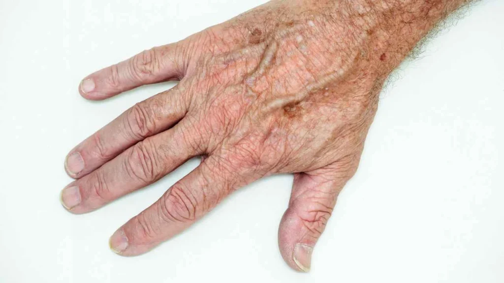 Male hand showing age spot Salford