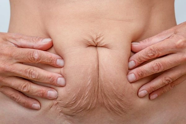 Image of a woman's stomach with loose skin - example of skin tightening Salford options