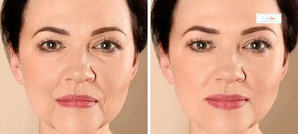 How Long Does It Take to See Results and How Long Do They Last Salford?